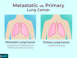 The most common types found in prostate cancer patients include: Metastatic Cancer To The Lungs Symptoms And Treatment