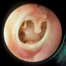 It could be something as innocuous as a hair touching your eardrum or an insect deep in your ear canal. Managing Middle Ear Fluid In Adults Tinnitus Treatment Hearing Aids Hearing Loss Rochester Ny