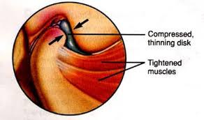 My jaw deviates to the left and right while opening and ends on the left when fully open (self.tmj). Tmj Tmd Overview Dr Brock Rondeau Associates