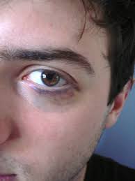 Un œil au beurre noir (ou cocard) est une ecchymose entourant l'œil consécutive à un traumatisme de la face généralement à la suite d'une chute ou d'un coup ou consécutivement à une opération de chirurgie esthétique. Dissimuler Un Oeil Au Beurre Noir Beauty And The Chihuahua