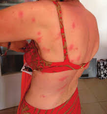 Image result for Cimex lectularius bites