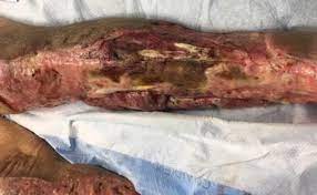 Guideline only/not a substitute for clinical judgment 6. Cureus The Use Of V A C Veraflo Cleanse Choice In The Burn Population