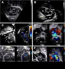 Aggressive Aortopathy In Neonatal Marfan Syndrome Journal Of Congenital Cardiology Full Text