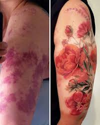 Arm Birthmark Cover Up Tattoo Pin On Ink