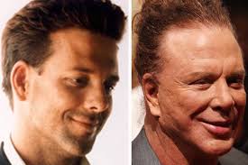 Mickey Rourke Wig Hair Transplant Pictures Celebrity Plastic Surgery Plastic Surgery Fail Plastic Surgery Gone Wrong