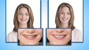 You return to pines dental associates in about three weeks for fitting and care instructions. Introduction To The Snap On Smile Provisional Appliance Youtube