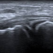 Prendre rdv pour une échographie pelvienne à paris. Infiltration Coude Sous Echo Ou Radio Paris 18 17 9 93 92 Imbm Doctolib