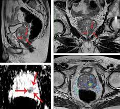 Mr imaging for diagnosis and staging of prostate cancer has clinically available and used by several centers for many years. Mri Effective Diagnostic Method Vitus Prostate Center