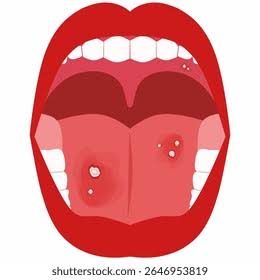 Cancer de boca: Más de 4 mil ilustraciones y dibujos de stock con licencia libres de regalías | Shutterstock