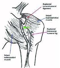 We did not find results for: Artistic Illustration Exhibits A Ruptured Transverse Humeral Ligament Download Scientific Diagram