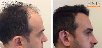 30 giovani uomini su 100 soffrono di perdita di capelli precoce e questo è dovuto a cause genetiche ed ereditarie. Trapianto Capelli In Paziente Giovane Trapianto Capelli Hsd