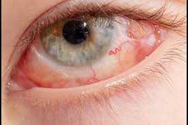 Image result for Retinal Detachment
