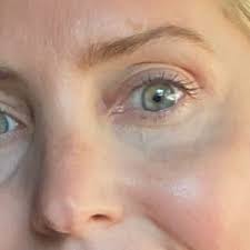 According to zeichner, retinol stimulates collagen and helps thicken the skin's foundation, making fine lines and crepeyness less apparent. Treatment For Crepey Skin Under Eyes I M 40 Yrs Old Photos