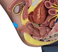 Image result for Rectal prolapse