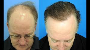 Pour les cas de calvitie débutante ou légèrement installée, de nombreux produits vendus sans la greffe de cheveux est une solution plus radicale pour les calvities avancées ou complètes. Comment Stopper La Calvitie Naturellement Eviter La Perte De Cheveux Chez Les Hommes Youtube