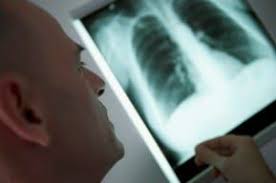 Mesothelioma takes a lot from a person: New Jersey Mesothelioma Asbestos Attorneys Dss Law P C