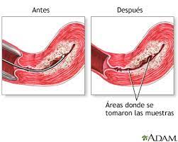 Serie Del Procedimiento De Dilatacion Y Legrado Cuidados Postoperatorios Medlineplus Enciclopedia Medica
