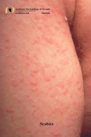 Image result for scabies on genitals