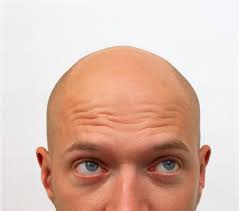 Massive hair loss at the back of the head. What Is Male Pattern Baldness Is It Inherited From Your Parents And What Are The Early Signs