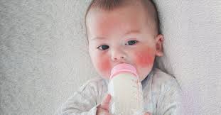 Dairy allergy is one of the most common food allergies in infants and toddlers. Lactose Intolerance Vs Milk Allergy In Babies Why Your Child Is Reacting To Milk