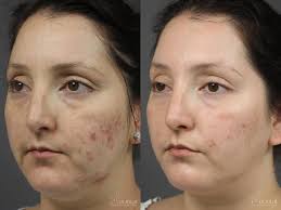 Acne Scars Before & After Gallery: Patient 10