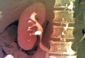 Slideshow A Visual Guide To Kidney Stones Calculos Renales Salud Y Ejercicio Rinones