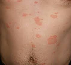 This is then followed, days to weeks later, by a rash of many similar but smaller round or oval lesions, mainly on the trunk and upper limbs. Pityriasis Rosea Gp Raj