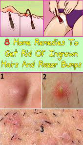 What do you think when someone says the word ugly? 8 Home Remedies To Get Rid Of Ingrown Hairs And Razor Bumps Skin Bumps Treat Ingrown Hair Ingrown Hair