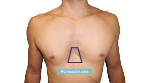Image result for Pectus Excavatum