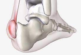 1 an isolated haglund's deformity can lead to posterior heel pain in runners due to adjacent soft traditional radiographic parameters one would use to measure haglund's deformity on plain films. Haglund S Deformity Causes Symptoms And Treatment