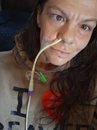 I'm getting a peg tube inserted in 2 weeks I feel my life is over 69in june 