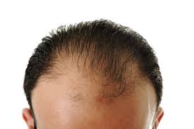 Sean focuses on natural and long lasting results of hair restoration for people suffering from hair loss. Prp Los Angeles Platelet Rich Plasma Prp Treatment For Hair Loss