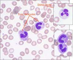 Physiologically, true dohle bodies represent rough endoplasmic reticulum &/or aggregates of ribosomes. Dohle Bodies Leukemia Symptoms
