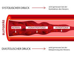 Wann der blutdruck zu niedrig ist, welche ursachen es gibt und was man dagegen tun kann, lesen sie hier! Welche Rolle Spielen Blutdruck Und Puls Beim Herzinfarkt