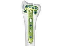 Distal Volar Rim Radial Locking Plate,Medical Device ...
