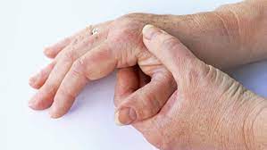 Gichtanfall Symptom Ursachen Diagnose Und Behandlung