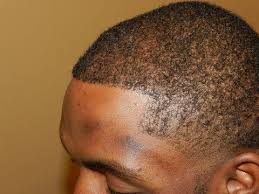 Sukkar provides his houston patients with access to fue hair restoration, a revolutionary new treatment that is proven to restore your full and luxurious head of hair. Pin On Medical Hair Transplant And Aesthetics