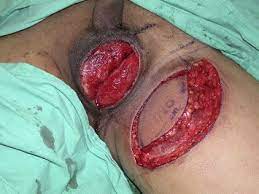 Fournier's gangrene severity index as a predictor of outcome in patients with fournier's gangrene: Reconstruction Of Scrotal And Perineal Defects In Fournier S Gangrene Journal Of Plastic Reconstructive Aesthetic Surgery