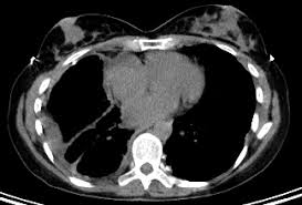 Worrisome lesions seen on ct imaging would prompt a biopsy attempt to confirm the diagnosis. Mesothelioma Symptoms Diagnosis And Treatment Bmj Best Practice Us