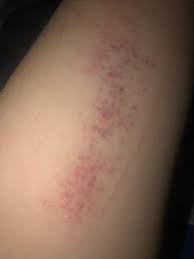 Was Ist Das Am Arm Bluterguss Gesundheit