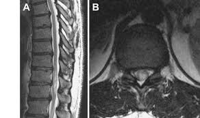 A Sagittal T2 Weighted Mri Demonstrates Mild Fusiform Enlargement Of Download Scientific Diagram