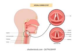 Image result for Hoarseness