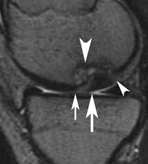 Image result for Ballottable Patella Sign