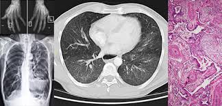 Infecții respiratorii și pneumonii, înregistrate cu sutele în. Boala PulmonarÄ InterstiÈialÄ DeterminÄ 35 Dintre Decesele Inregistrate La PacienÈii Cu Sclerodermie Raportul De GardÄ