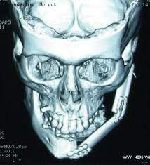 Learn more about osteosarcoma here. Osteosarcoma Of The Jaw Classification Diagnosis And Treatment Intechopen