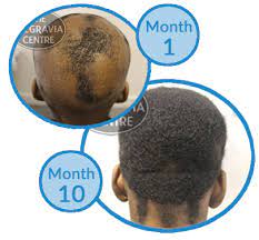 The main reason that hair loss is reversible is that male pattern baldness is not natural. Reversible Forms Of Female Hair Loss