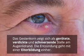 Hordeolum) sind bestimmte drüsen am augenlid mit bakterien infiziert. Gerstenkorn Ursachen Und Behandlung