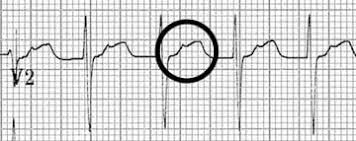 Your doctor may also order several tests to check your heart health. Supraventricular Tachycardia Svt Litfl Ecg Library Diagnosis