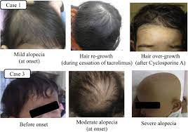 A toxic effect on the central nervous system, which consists of the brain and spinal cord. Alopecia In Children Following Living Related Liver Transplantation Sciencedirect