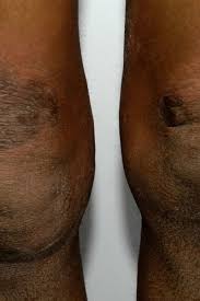 Eczema On Black Skin Pictures Symptoms And Treatment Find & download free graphic resources for eczema. eczema on black skin pictures